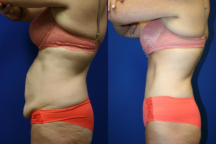 Tummy Tuck Case 81 Before & After Left Side | Downers Grove, IL | Dr. Sandeep Jejurikar