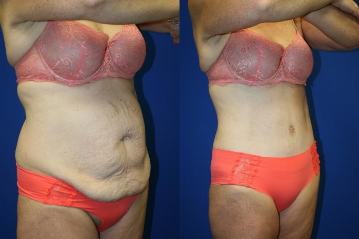 Liposuction Case 81 Before & After Right Oblique | Downers Grove, IL | Dr. Sandeep Jejurikar