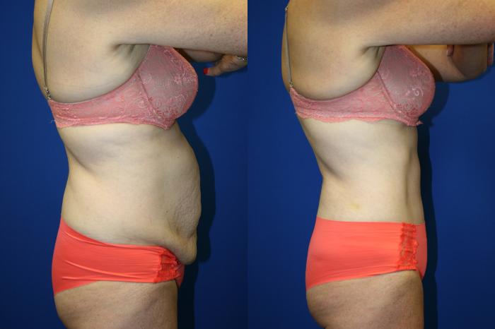 Tummy Tuck Case 81 Before & After Right Side | Downers Grove, IL | Dr. Sandeep Jejurikar