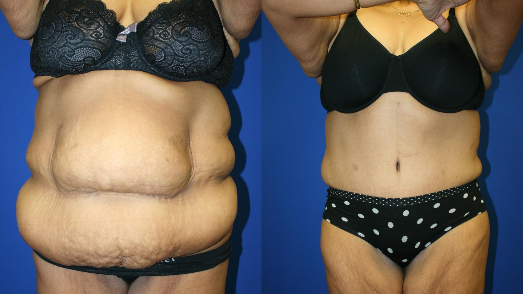 Tummy Tuck Case 88 Before & After Front | Downers Grove, IL | Dr. Sandeep Jejurikar