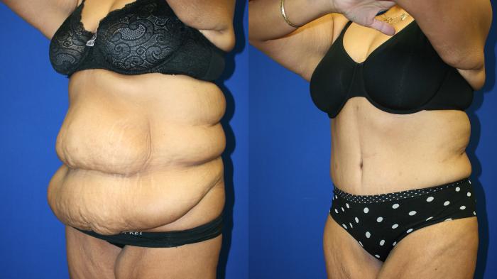 Liposuction Case 88 Before & After Left Oblique | Downers Grove, IL | Dr. Sandeep Jejurikar
