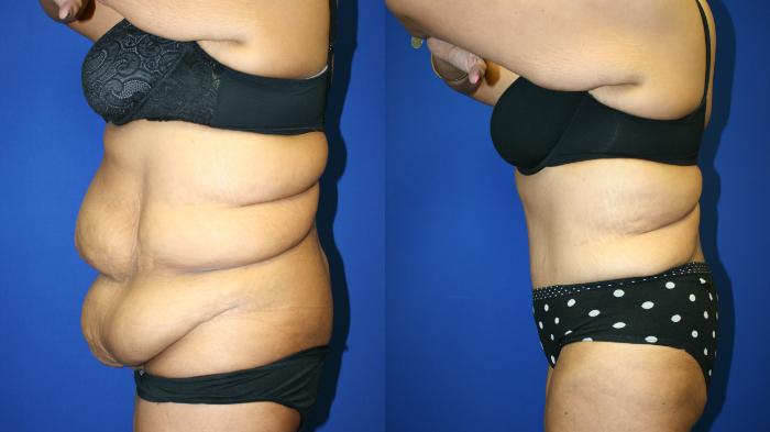Liposuction Case 88 Before & After Left Side | Downers Grove, IL | Dr. Sandeep Jejurikar