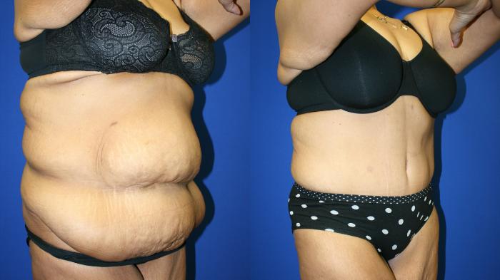 Liposuction Case 88 Before & After Right Oblique | Downers Grove, IL | Dr. Sandeep Jejurikar