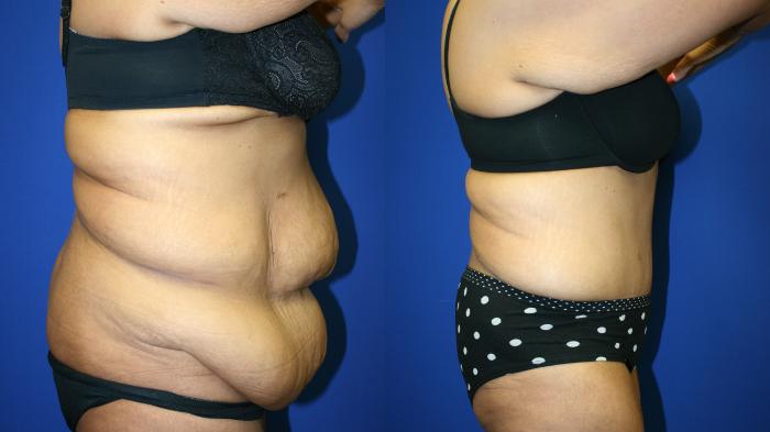 Tummy Tuck Case 88 Before & After Right Side | Downers Grove, IL | Dr. Sandeep Jejurikar