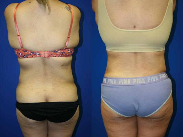 Liposuction Case 91 Before & After Back | Downers Grove, IL | Dr. Sandeep Jejurikar