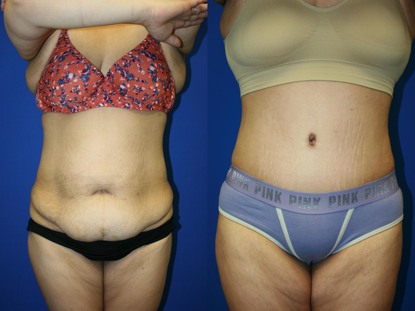 Tummy Tuck Downers Grove, Naperville & Plainfield