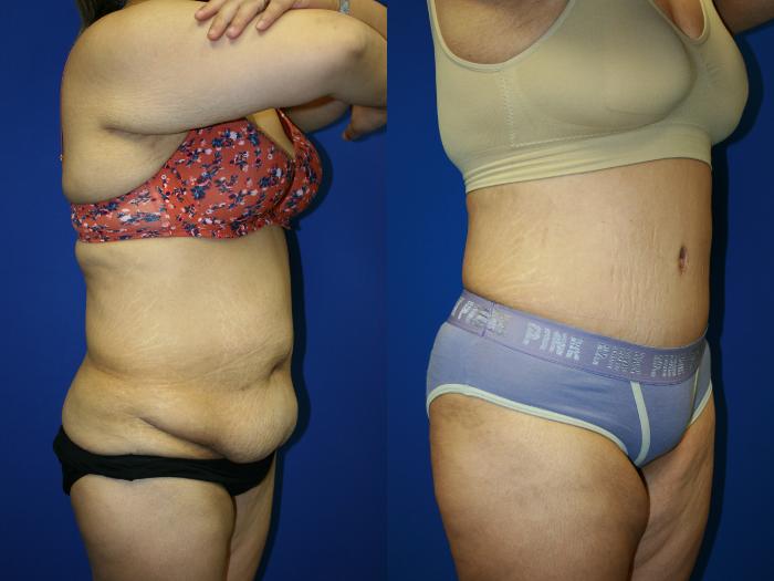 Liposuction Case 91 Before & After Right Oblique | Downers Grove, IL | Dr. Sandeep Jejurikar