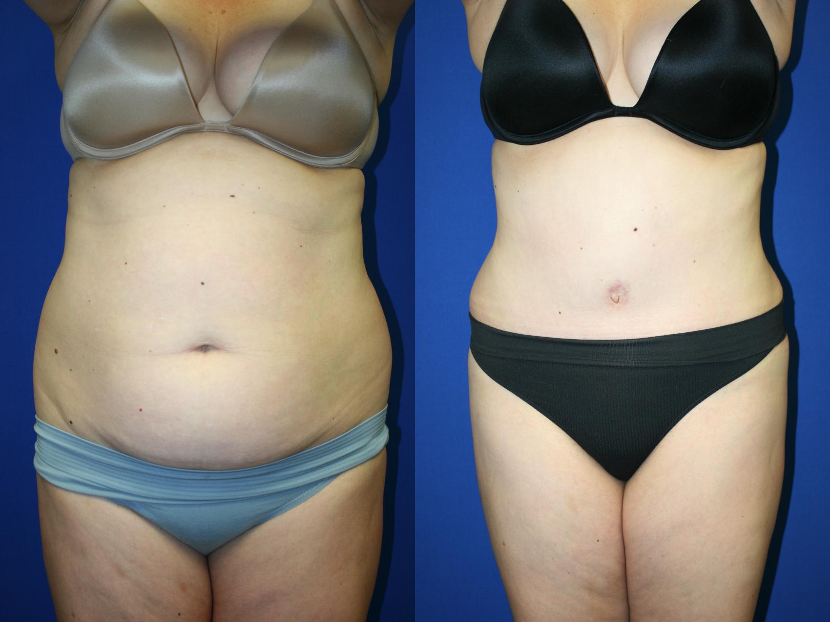 Tummy Tuck Case 95 Before & After Front | Downers Grove, IL | Dr. Sandeep Jejurikar