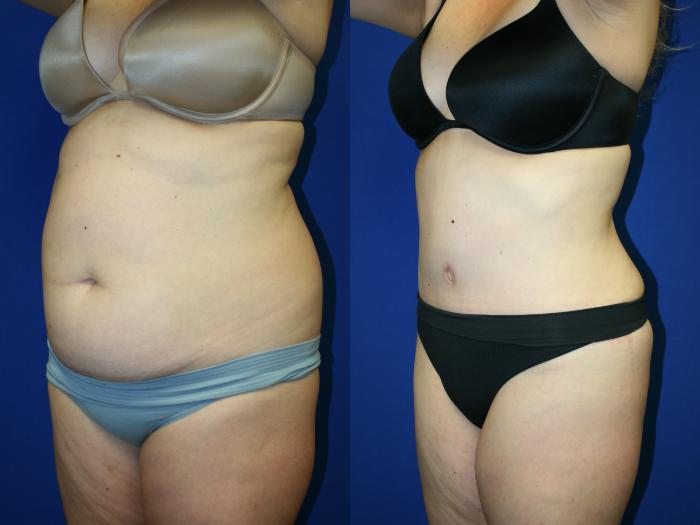 Liposuction Case 95 Before & After Left Oblique | Downers Grove, IL | Dr. Sandeep Jejurikar