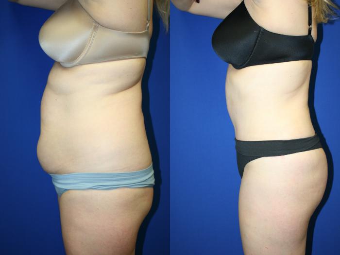 Tummy Tuck Case 95 Before & After Left Side | Downers Grove, IL | Dr. Sandeep Jejurikar